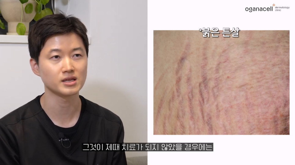 튼살큐어젯 고민을 해결하는 관련 이미지 13