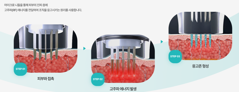 여드름 흉터 완벽 정리 관련 이미지 3