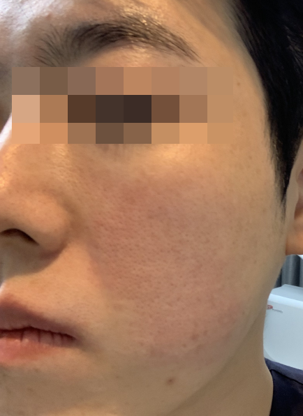 [동대문피부과] 모공, 좋아질수 있습니다! 관련 이미지 5
