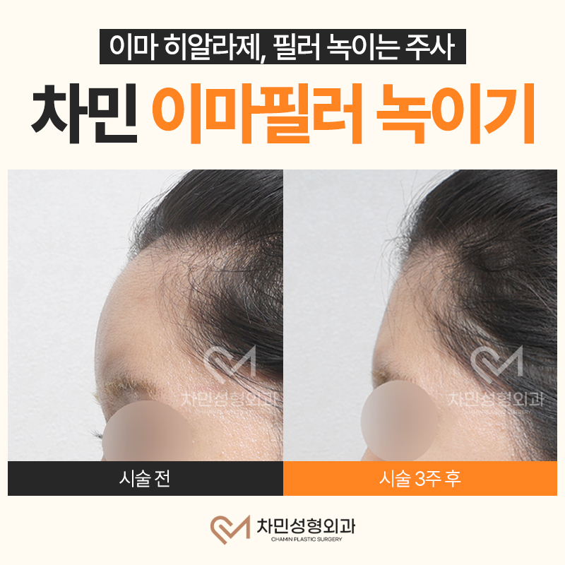이마필러 녹이기, 필러 녹이는 주사 비용, 병원은? 차민성형외과 관련 이미지 10
