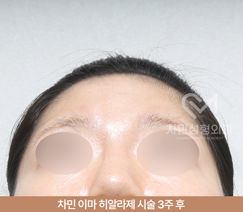 이마필러 녹이기, 필러 녹이는 주사 비용, 병원은? 차민성형외과 관련 이미지 9