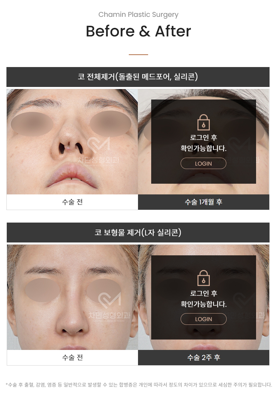 코수술 후 코막힘, 이물감, 불안할 때 [차민 기능코제거] 관련 이미지 13