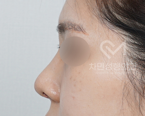 튀어나온 메드포어 제거, 실리콘,  비주 피부 결손, 돌출 및 패임, 염증 진행 중 관련 이미지 10