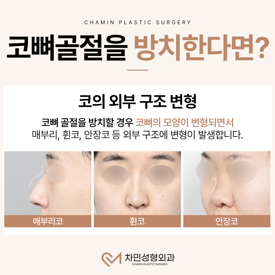 코뼈 골절 병원, 수술, 부러짐 증상이 느껴질 때 당일 진료! 관련 이미지 3