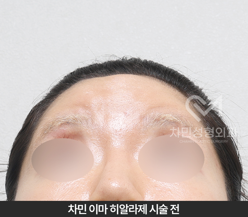 이마필러 녹이기, 필러 녹이는 주사 비용, 병원은? 차민성형외과 관련 이미지 5