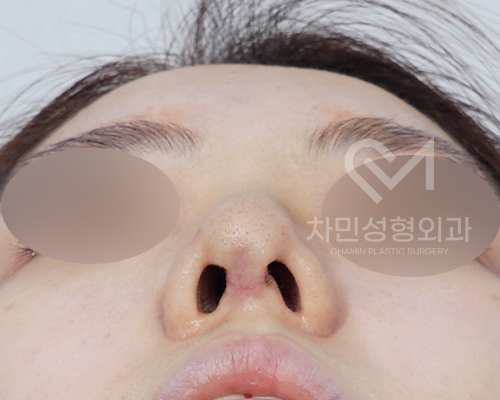 튀어나온 메드포어 제거, 실리콘,  비주 피부 결손, 돌출 및 패임, 염증 진행 중 관련 이미지 8