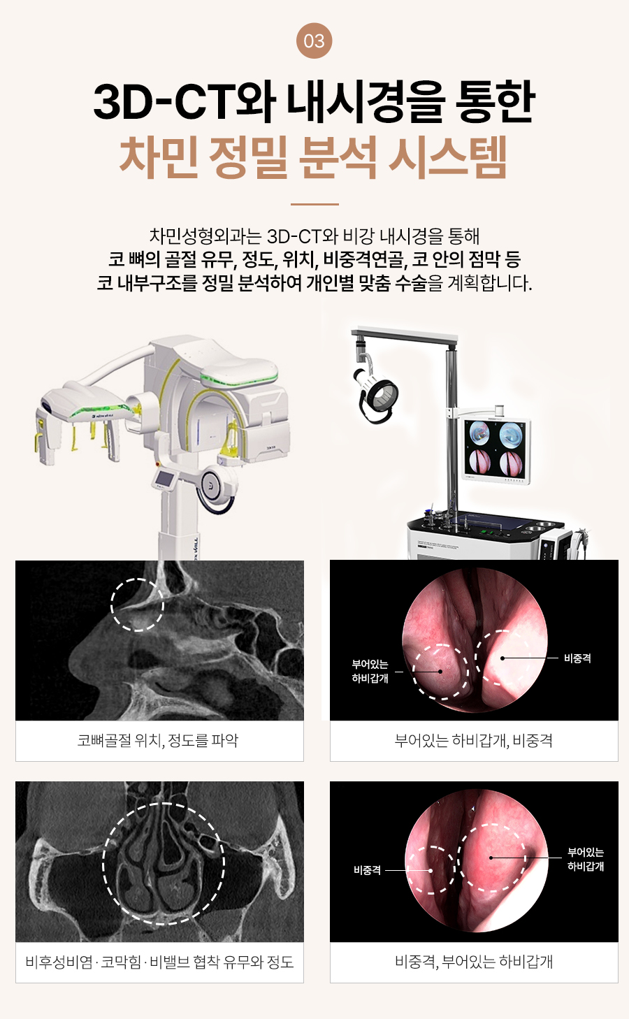 코뼈 골절 병원, 수술, 부러짐 증상이 느껴질 때 당일 진료! 관련 이미지 13