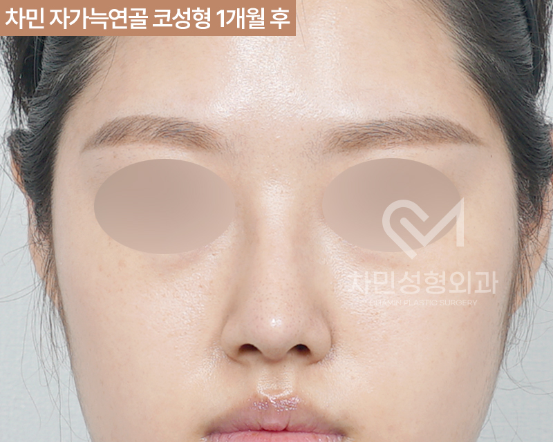 코수술 자가늑 1개월 : 짧은코, 들창코 케이스 리뷰 관련 이미지 8