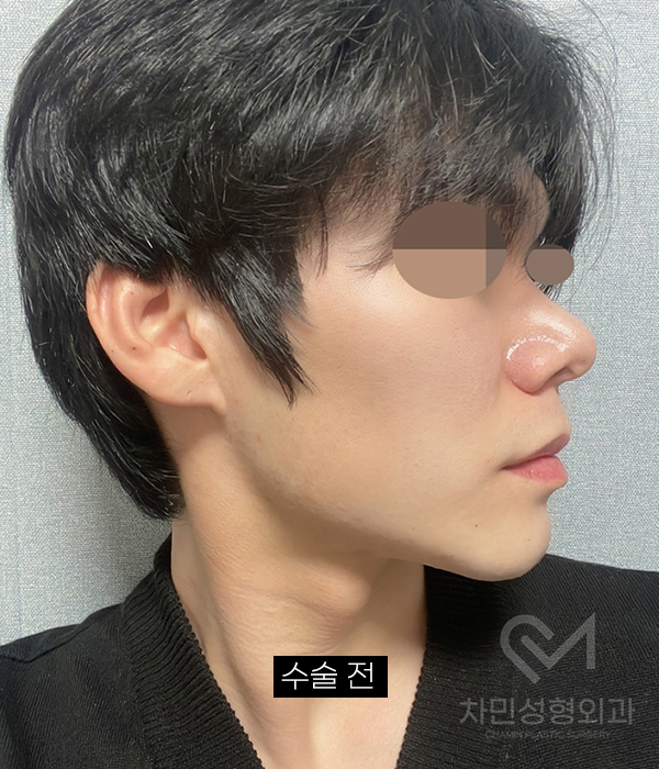 코재건 수술 (안장코, 찝힌코, 함몰, 구축) 극한코 사례 관련 이미지 13