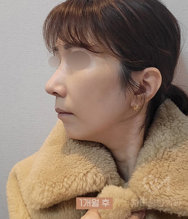 Removal of Nose Silicone, Ear Cartilage, Medpor, and Tip Cartilage Repositioning (Before Surgery ~ 2 Months) image 14