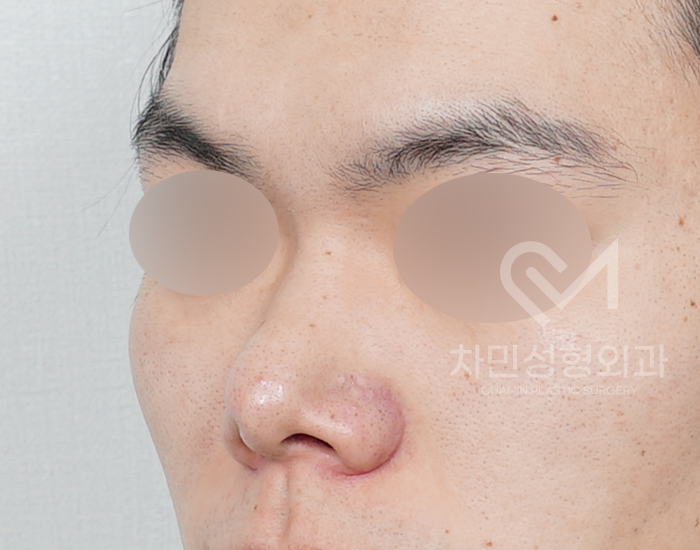 코재건 수술 (안장코, 찝힌코, 함몰, 구축) 극한코 사례 관련 이미지 3
