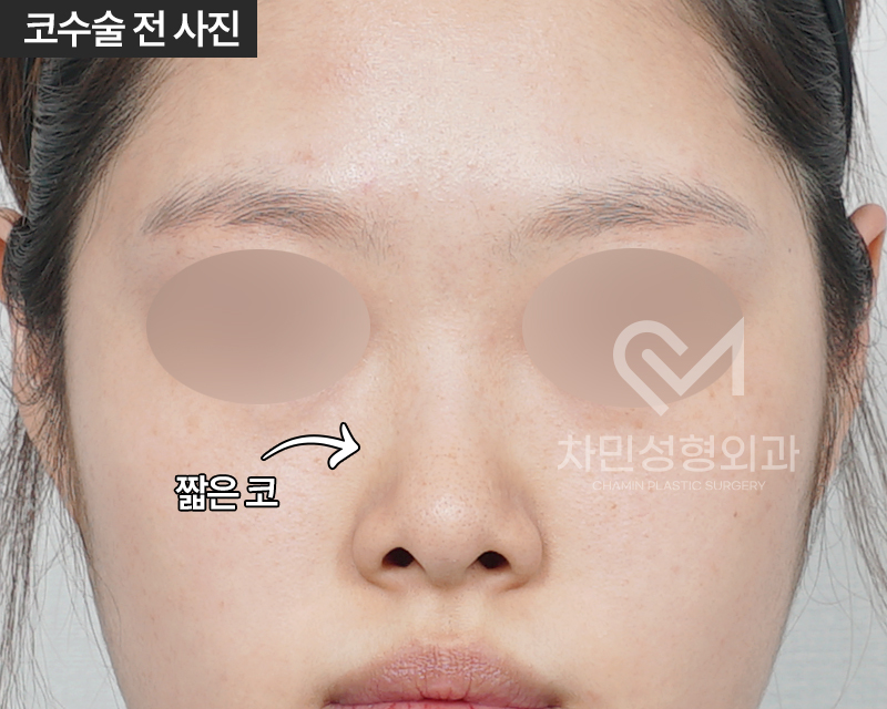 코수술 자가늑 1개월 : 짧은코, 들창코 케이스 리뷰 관련 이미지 2