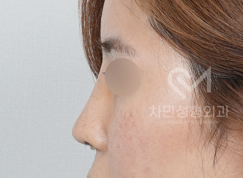 Ninth Revision Rhinoplasty for Contracted Nose: Pinched Nose, Depression, Autologous Rib Cartilage, Saddle Nose image 8
