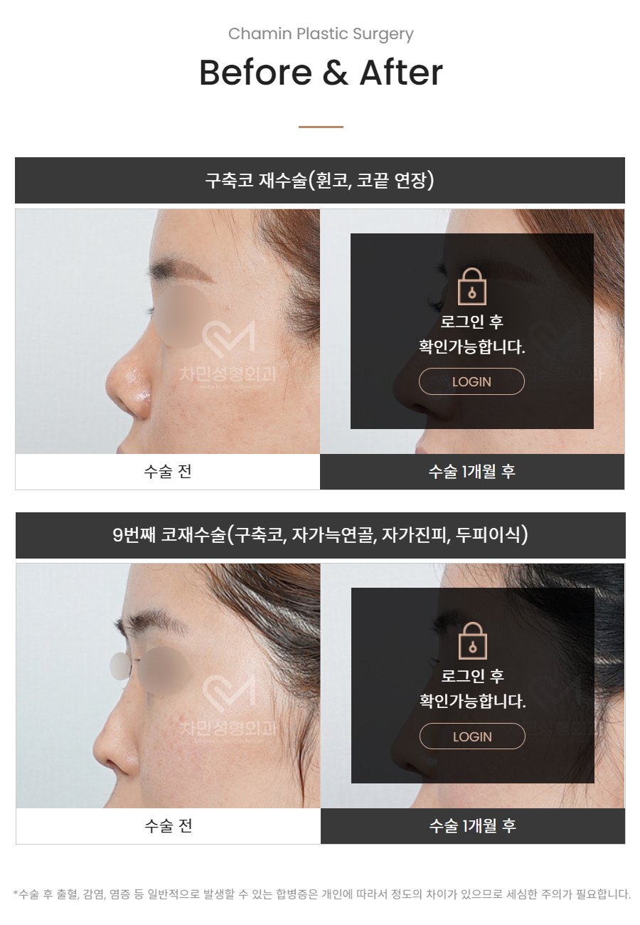 코재건 수술 (안장코, 찝힌코, 함몰, 구축) 극한코 사례 관련 이미지 17