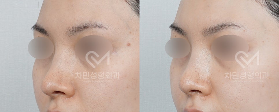 Case Review of Total Nose Removal (Removal of Donated Rib Cartilage, Cartilage Repositioning) ｜Director Minseong Kim image 5