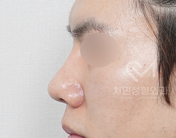코재건 수술 (안장코, 찝힌코, 함몰, 구축) 극한코 사례 관련 이미지 11