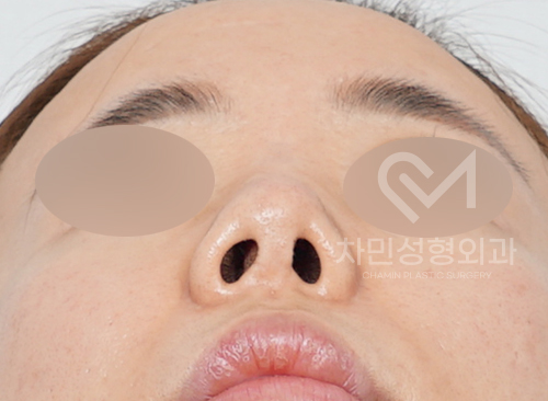 코수술 후 구축으로 짧고 들린 코 (휜코, 코끝 길이 연장, 자가늑연골) 관련 이미지 2
