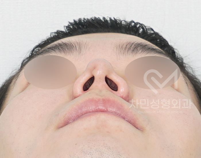 코재건 수술 (안장코, 찝힌코, 함몰, 구축) 극한코 사례 관련 이미지 2