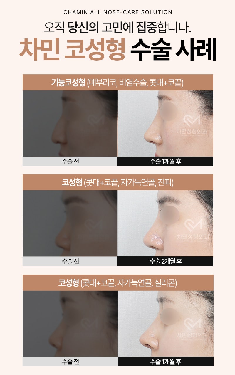2 Weeks After Rib Cartilage Rhinoplasty: Short Nose Surgery Review, Columella Correction Case image 11