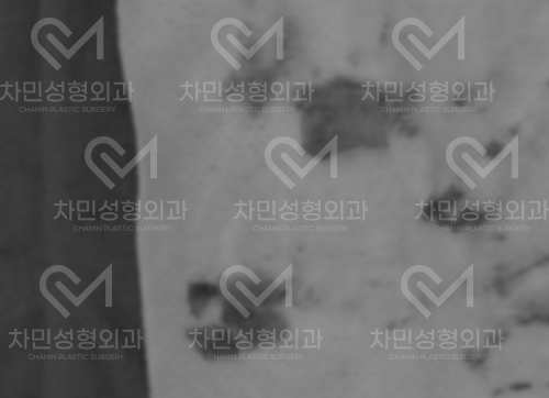 튀어나온 메드포어 제거, 실리콘,  비주 피부 결손, 돌출 및 패임, 염증 진행 중 관련 이미지 6