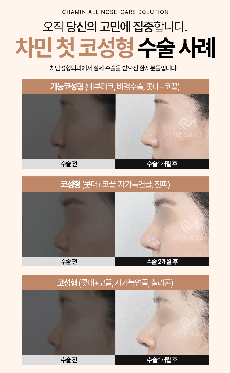 코수술 자가늑 1개월 : 짧은코, 들창코 케이스 리뷰 관련 이미지 12