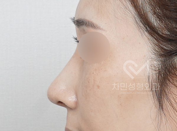 Removal of Nose Silicone, Ear Cartilage, Medpor, and Tip Cartilage Repositioning (Before Surgery ~ 2 Months) image 9