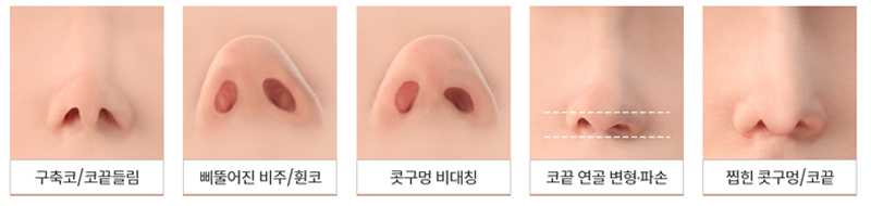 Case Review of Total Nose Removal (Removal of Donated Rib Cartilage, Cartilage Repositioning) ｜Director Minseong Kim image 13