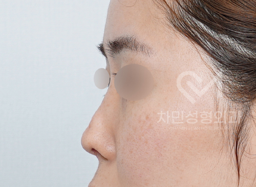 Ninth Revision Rhinoplasty for Contracted Nose: Pinched Nose, Depression, Autologous Rib Cartilage, Saddle Nose image 3