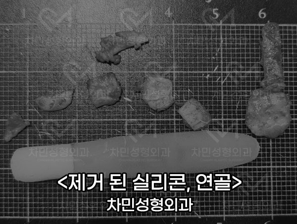 Removal of Nose Silicone, Ear Cartilage, Medpor, and Tip Cartilage Repositioning (Before Surgery ~ 2 Months) image 5