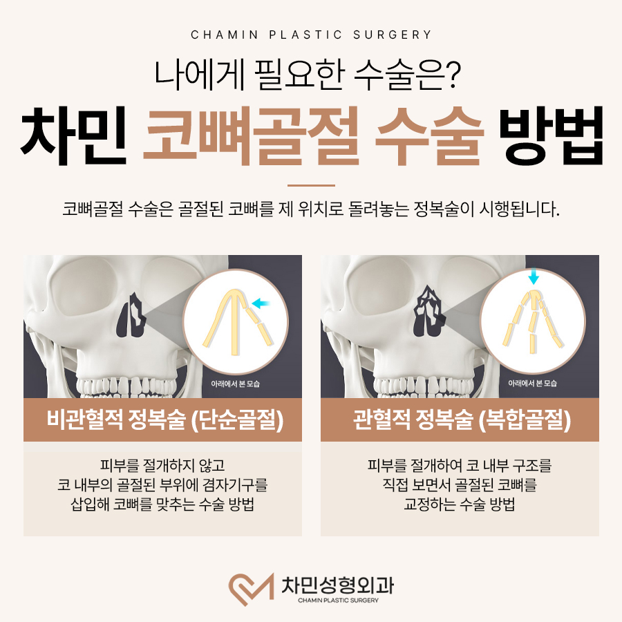 코뼈 골절 병원, 수술, 부러짐 증상이 느껴질 때 당일 진료! 관련 이미지 8