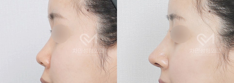 Female Straight Nose: Case Review of a Well-Known Rhinoplasty Clinic! image 7