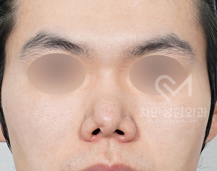 코재건 수술 (안장코, 찝힌코, 함몰, 구축) 극한코 사례 관련 이미지 1