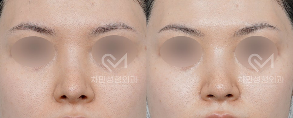 Case Review of Total Nose Removal (Removal of Donated Rib Cartilage, Cartilage Repositioning) ｜Director Minseong Kim image 4