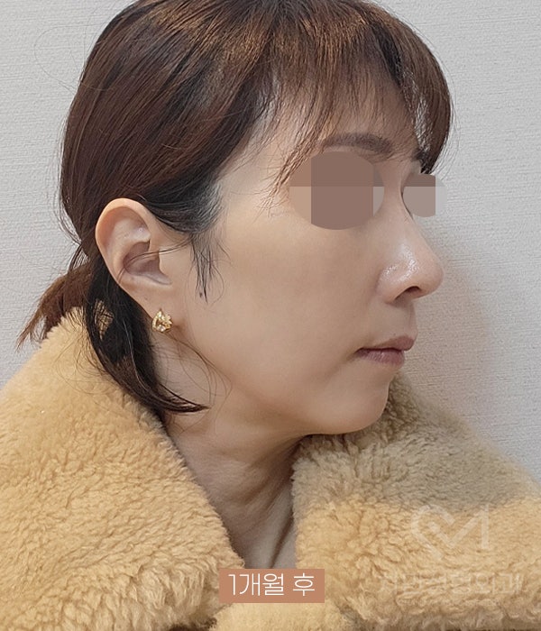 Removal of Nose Silicone, Ear Cartilage, Medpor, and Tip Cartilage Repositioning (Before Surgery ~ 2 Months) image 15