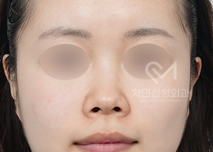 Female Straight Nose: Case Review of a Well-Known Rhinoplasty Clinic! image 1