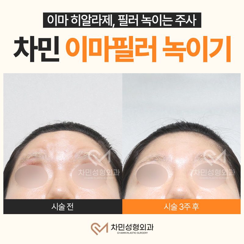 이마필러 녹이기, 필러 녹이는 주사 비용, 병원은? 차민성형외과 관련 이미지 11