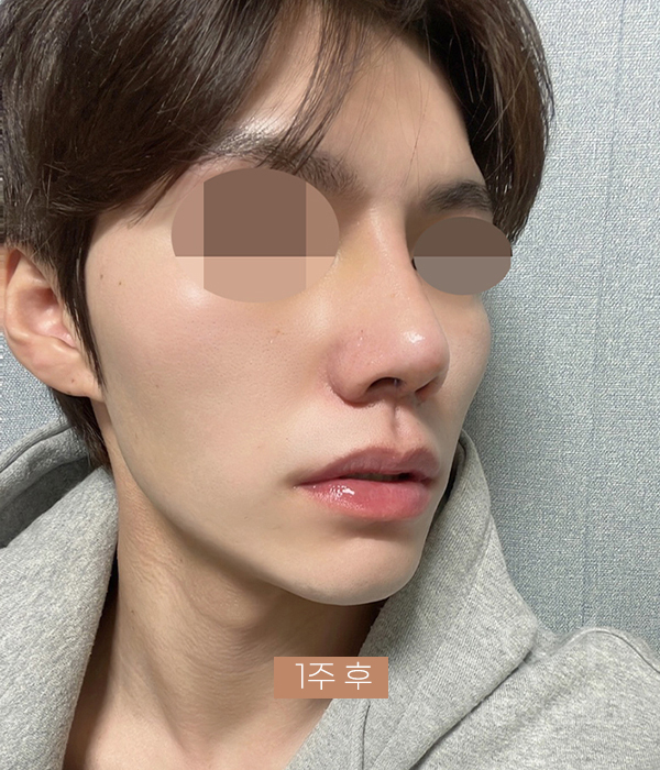 코재건 수술 (안장코, 찝힌코, 함몰, 구축) 극한코 사례 관련 이미지 14