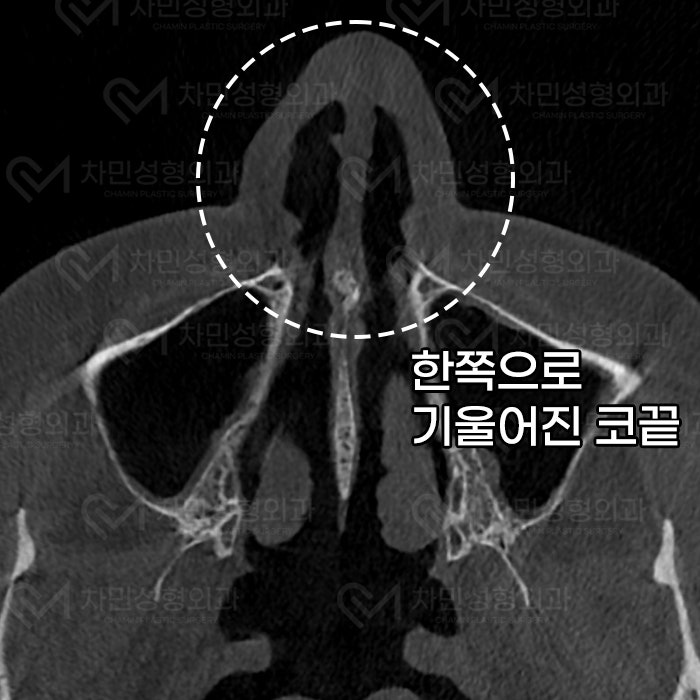 Removal of Nose Silicone, Ear Cartilage, Medpor, and Tip Cartilage Repositioning (Before Surgery ~ 2 Months) image 4