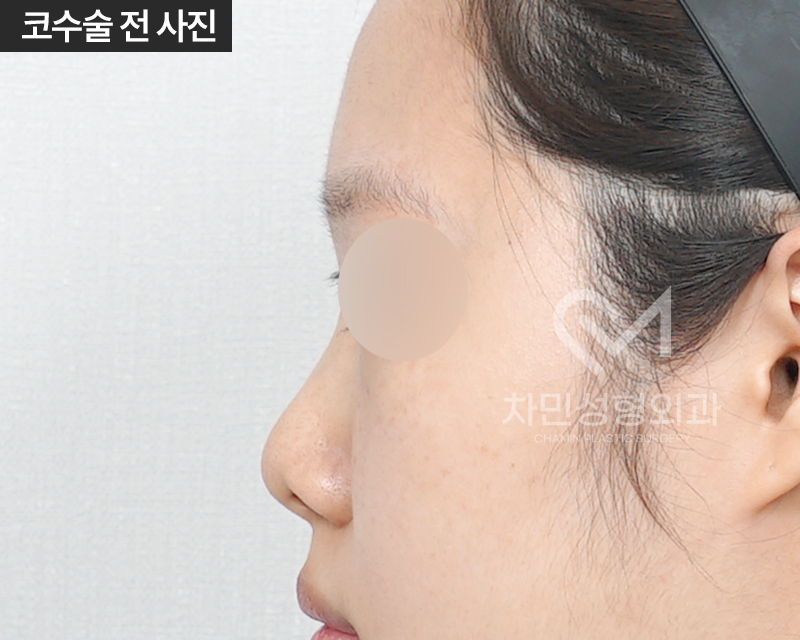 코수술 자가늑 1개월 : 짧은코, 들창코 케이스 리뷰 관련 이미지 5