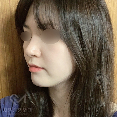 Case Review of Total Nose Removal (Removal of Donated Rib Cartilage, Cartilage Repositioning) ｜Director Minseong Kim image 9
