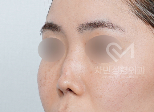 Ninth Revision Rhinoplasty for Contracted Nose: Pinched Nose, Depression, Autologous Rib Cartilage, Saddle Nose image 2