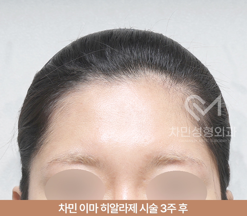 이마필러 녹이기, 필러 녹이는 주사 비용, 병원은? 차민성형외과 관련 이미지 7