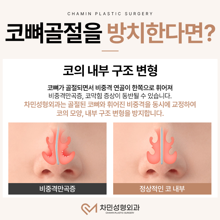 코뼈 골절 병원, 수술, 부러짐 증상이 느껴질 때 당일 진료! 관련 이미지 4