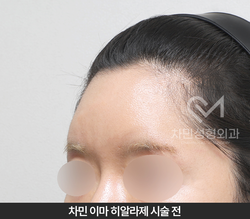 이마필러 녹이기, 필러 녹이는 주사 비용, 병원은? 차민성형외과 관련 이미지 2