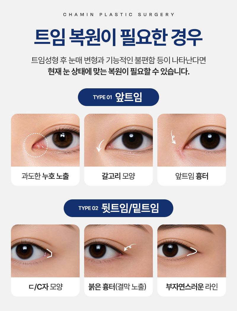 Eyelid Corner Revision and Reconstruction, Including Reoperation! Cha Min Plastic Surgery image 3