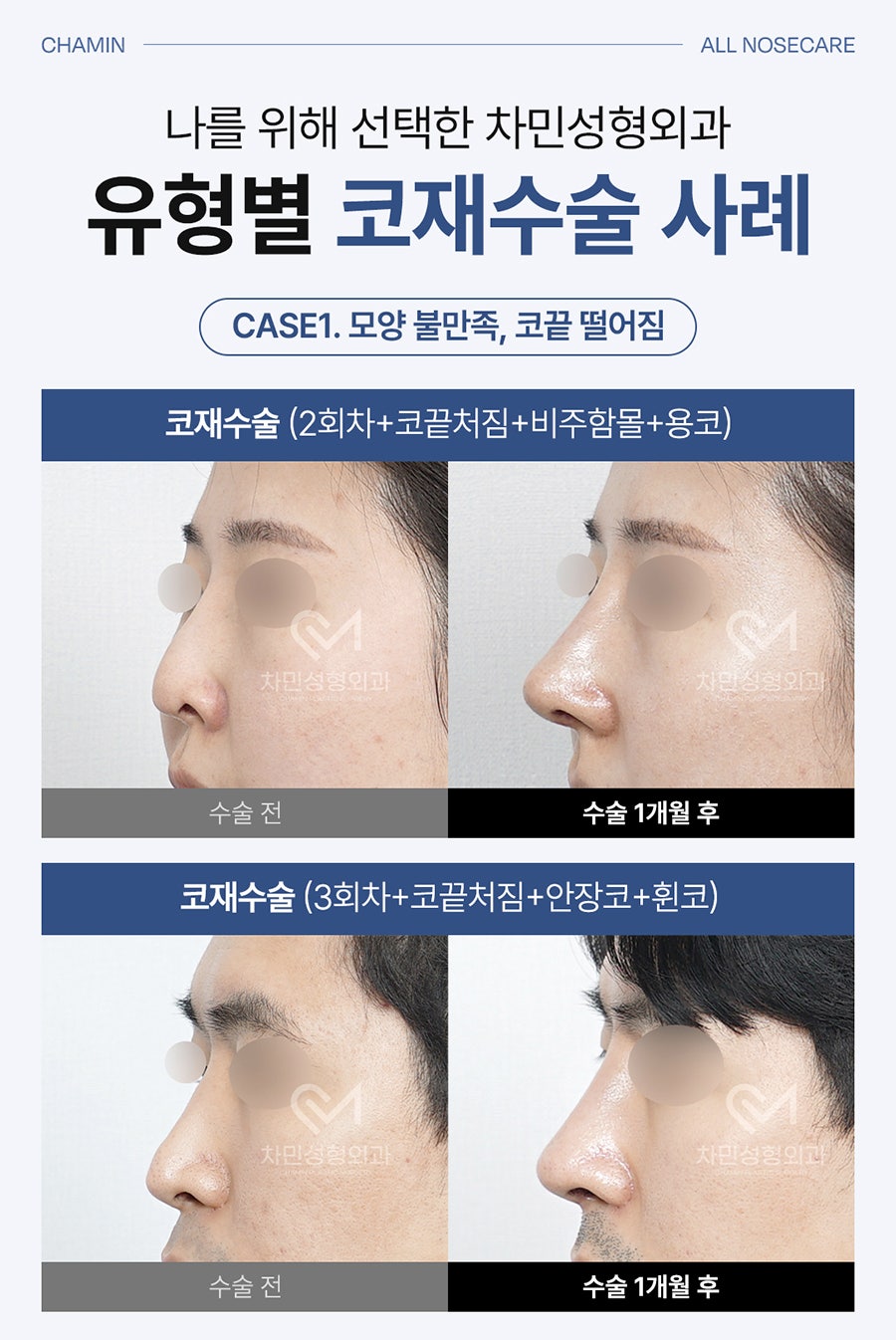 Cha Min Plastic Surgery’s All Nose Care Solution, from Nose Surgery to Nasal Reconstruction! image 5