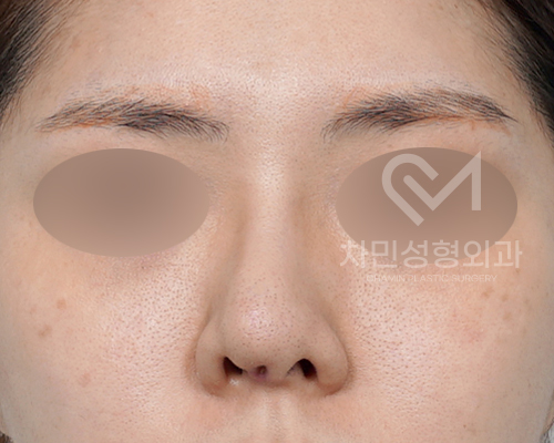튀어나온 메드포어 제거, 실리콘,  비주 피부 결손, 돌출 및 패임, 염증 진행 중 관련 이미지 1