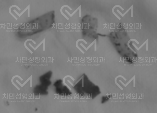 튀어나온 메드포어 제거, 실리콘,  비주 피부 결손, 돌출 및 패임, 염증 진행 중 관련 이미지 5