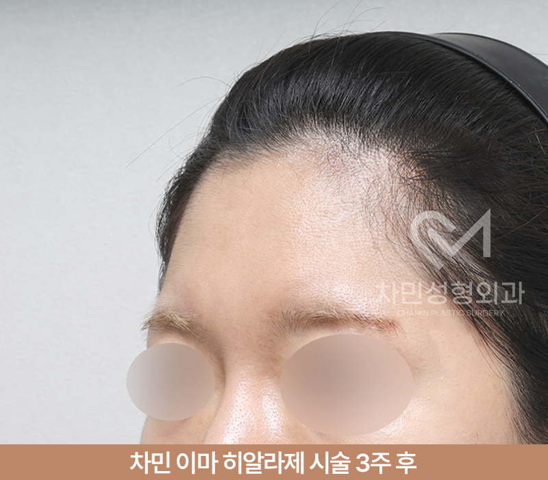 이마필러 녹이기, 필러 녹이는 주사 비용, 병원은? 차민성형외과 관련 이미지 6