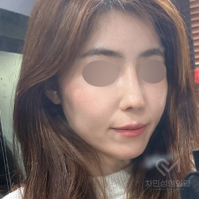 Ninth Revision Rhinoplasty for Contracted Nose: Pinched Nose, Depression, Autologous Rib Cartilage, Saddle Nose image 19